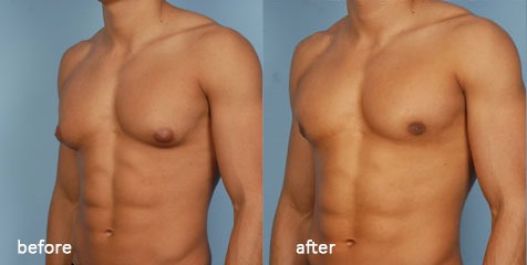 Male breasts from steroids